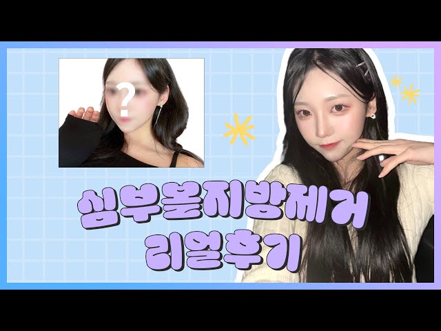 심부볼지방제거 리얼후기 궁금하신분은 바로 여기로!