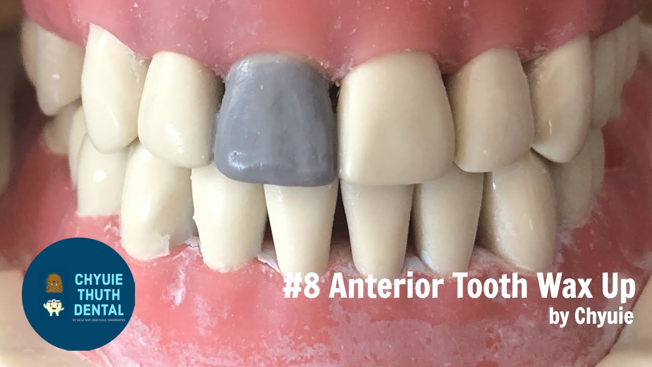 [ChyuieThuth] 8 Anterior Tooth Dental Wax Up YouTube