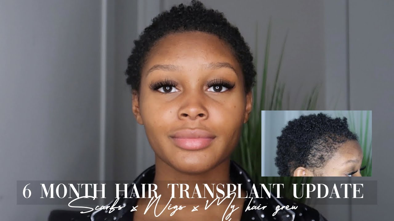 HAIR TRANSPLANT 6 MONTH UPDATE | LONGEVITA
