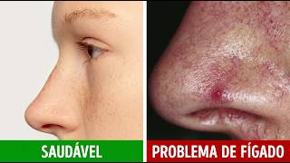 11 Sinais de Danos no Fígado Que Aparecem Meses Antes da Cirrose Hepática