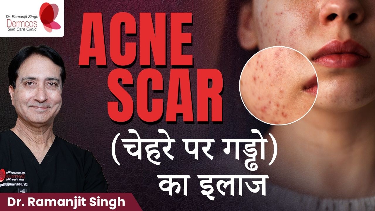 Acne Scar Treatment | Acne scars कैसे हटाएं?  | Dermcos Skincare Clinic