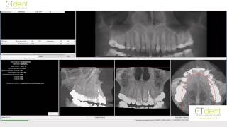 Downloading Icat Vision Scans