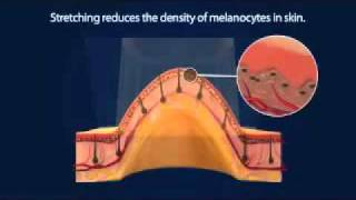 Laser Hair Removal With Lumenis Lightsheer