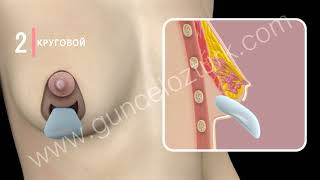 Как выглядит операция по подтяжке груди? 3D анимация - доктор Гюнсель Озтюрк. by Güncel Öztürk 59,893 views 3 years ago 2 minutes, 31 seconds