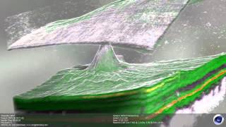 Vitreo Macular Traction Syndrom