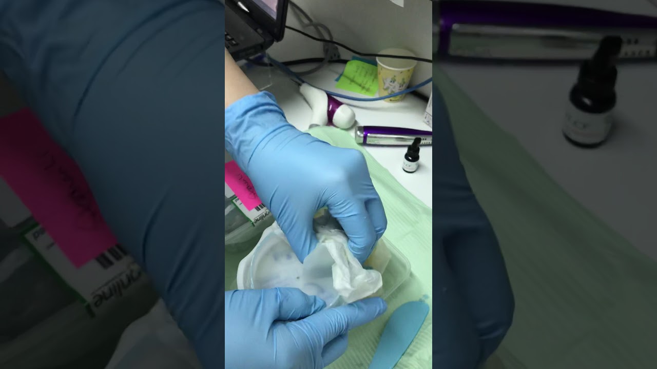 Impression for retainer 2