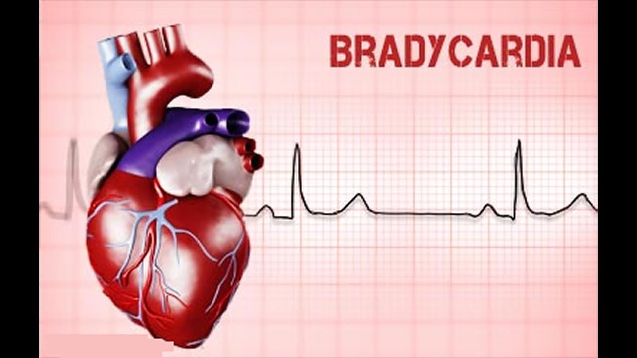 BRADİARİTMİLERE ACİL YAKLAŞIM KONU ÖZETİ