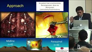 Minimally Invasive Spinal Surgery (MISS) - Neel Anand, MD