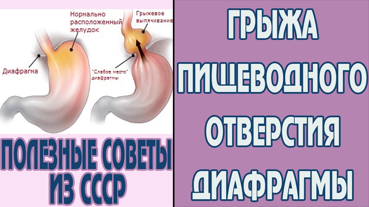 Почему грыжа пищевода. Грыжа пищевода упражнения. Упражнения при грыже пищеводного отверстия. Диета при грыже пищеводного отверстия. Упражнения при грыже пищеводного отверстия диафрагмы.