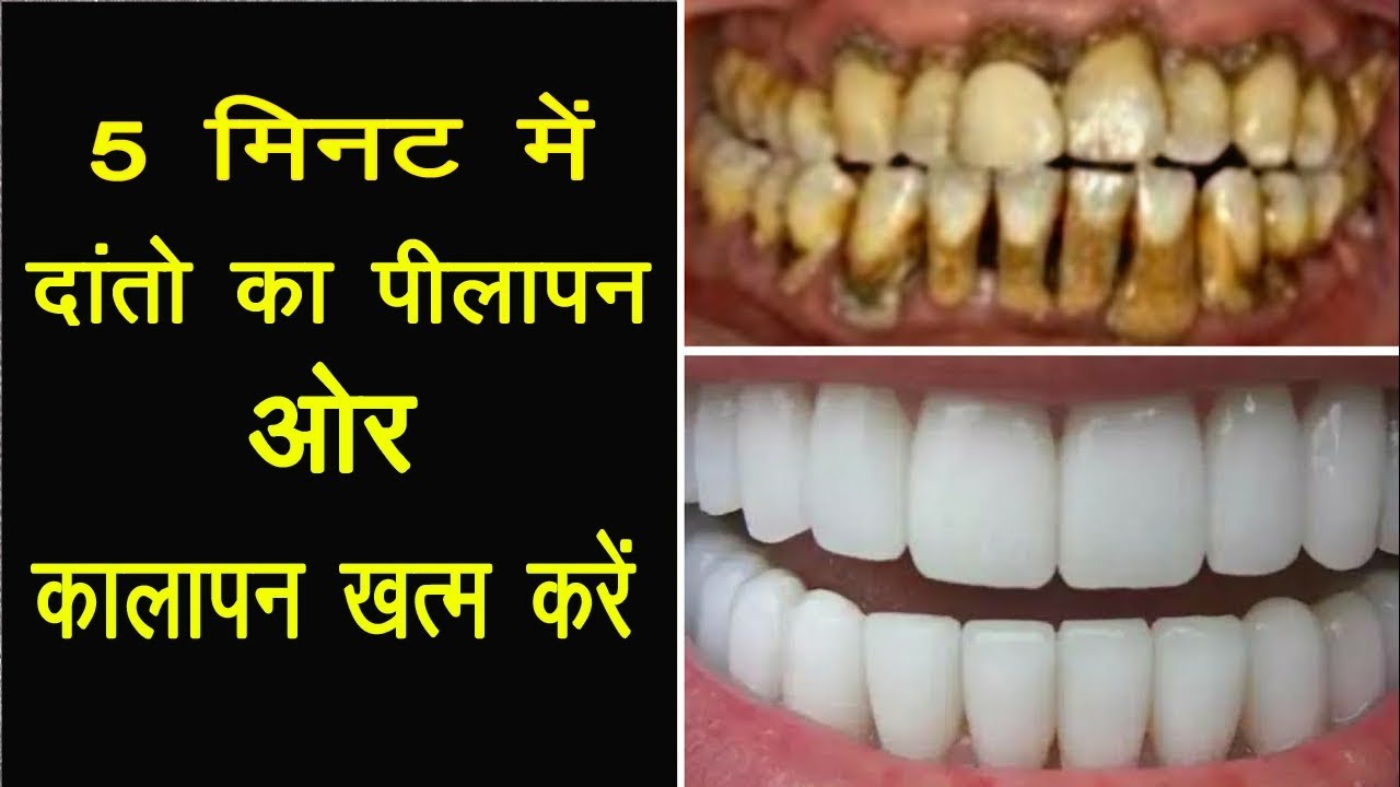 5 मिनट में दांतो का पीलापन और कालापन खत्म करे ! Teeth Whitening Tips In