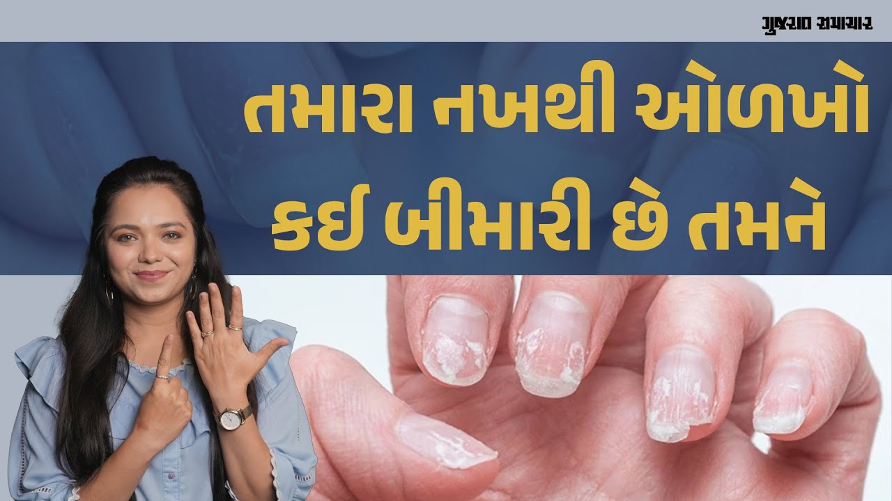 તમારા નખથી ઓળખો કઈ બીમારી છે તમને  | What Your Nails Can Tell You About Your Health