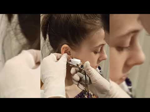 Прокол мочек ушей системой Studex 75 #пирсинг #детскийпирсинг