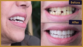 Eleninin Türkiyedeki Hollywood Smile Yolculuğu Estherian Clinic