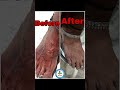 #highlights #ytshort #dermatologist #hijamacuppingtherapy #eczema #skincare