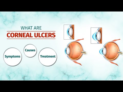 कॉर्नियल अल्सर क्या हैं? लक्षण, कारण, उपचार के विकल्प और अधिक