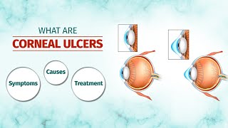 What Are Corneal Ulcers Symptoms Causes Treatment Options And More