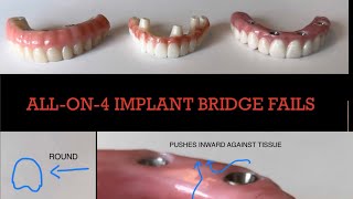 HUGE Failures with All on 4 Dental Implant Bridges