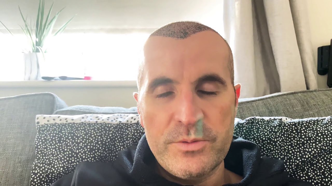 Day 2 Bandage Removal! Hair Transplant at Baruch Hair Loss Clinic