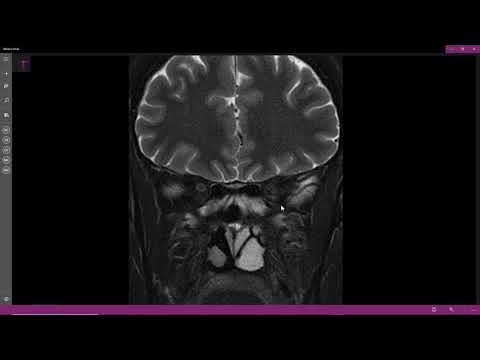 Video: Cellule T In Miosite