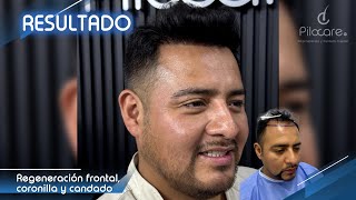 Resultado - Regeneración Frontal, coronilla y candado - CDMX