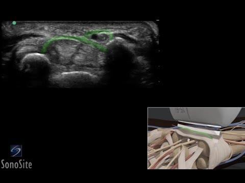 Image of How To: Wrist - Median Nerve Entrapment 3D Video