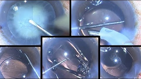 Is this a Posterior capsular rent or is this a Zonular dialysis? A small diagnostic dilemma in phaco