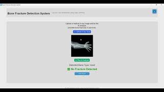 Bone Fracture Detection System