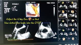 How Do I Confirm With 3D Whether Prosthetic Heart Valve Stenosis Is Due To Pannus ?