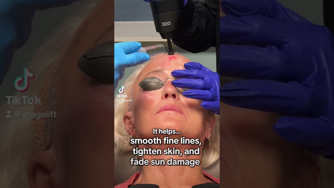 ✨ 𝐁𝐀𝐁𝐘 𝐂𝐎₂ 𝐋𝐀𝐒𝐄𝐑 — 𝐒𝐌𝐀𝐋𝐋 𝐓𝐑𝐄𝐀𝐓𝐌𝐄𝐍𝐓, 𝐁𝐈𝐆 𝐆𝐋𝐎𝐖 ✨