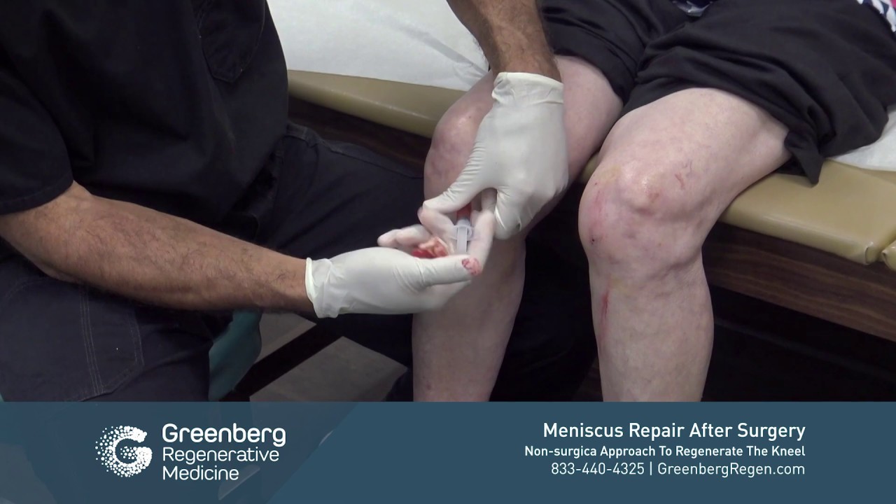 Meniscus Regeneration After Ineffective Surgery