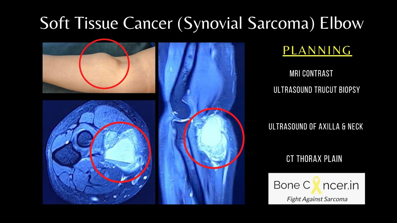 Treatment for Soft tissue Cancer (Synovial Sarcoma) of Elbow: Limb Salvage Surgery, Dr Srimanth B S