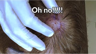 Round Ball Cyst Discovered in Scalp! | CONTOUR DERMATOLOGY