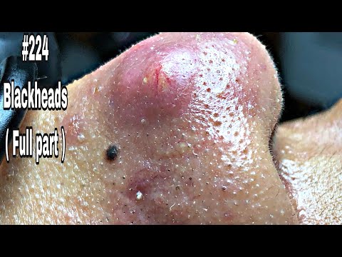 Unmasking the Truth About Huge Blackheads on Your Nose - Final Thoughts