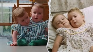They Were Born Joined in Ireland Only One Survived