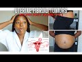 Massive Fibroid Tumors Journey | My Symptoms, Diagnosis, and Pre-Op Myomectomy/C-Section