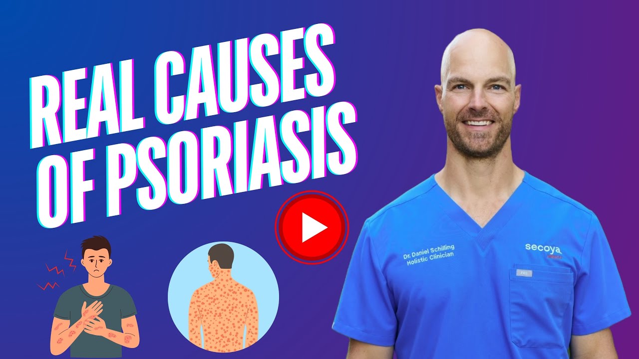 What Are the Real Causes of Psoriasis? 😣