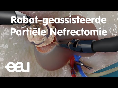Video: Robots In Laparoscopische Chirurgie: Huidige En Toekomstige Status