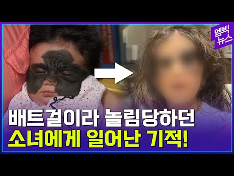 얼굴에 &amp;#39;초거대 반점&amp;#39; 아기..무려 6번의 수술 끝에 최근 모습이 공개됐는데...
