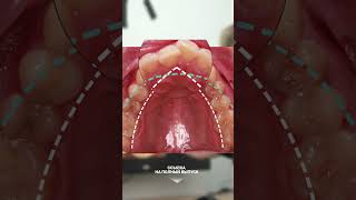 Кривые зубы испортили прикус #лечениезубов  #doremiclinic #неправильныйприкус