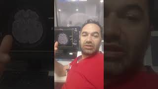 Flair İskemik Glotik Odak Nedir? Zararlımı? Şfet