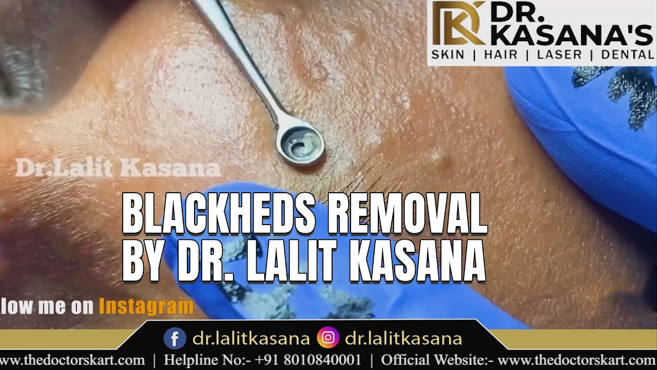 Dr Lalit kasana blackhead removal II Deep blackhead removal II by Dr