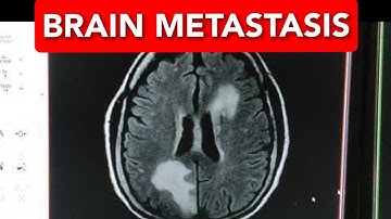 Brain Metastasis (BRAIN MRI)