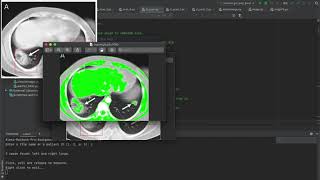 Stanford CS106A 'Code in Place' // Final Project – Detecting pneumonia