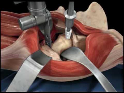 Total Hip Replacement Surgery Video, Hip Orthopaedics Videos