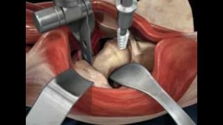 Direct Anterior Approach Hip Replacement