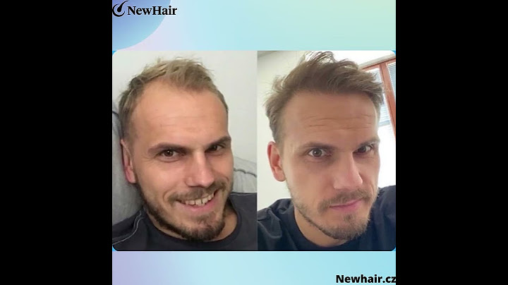 Transplantace vlasů pro muže | NewHair.cz