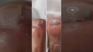 Pedicure Tutorial Nail Drill Damage Recovery