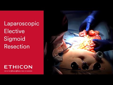 Video: Position Papir: Håndtering Af Perforeret Sigmoid Diverticulitis