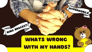 SWAN RING/RING SPLINTS~ MOBILITY AND PAIN MANAGEMENT ~hEDS