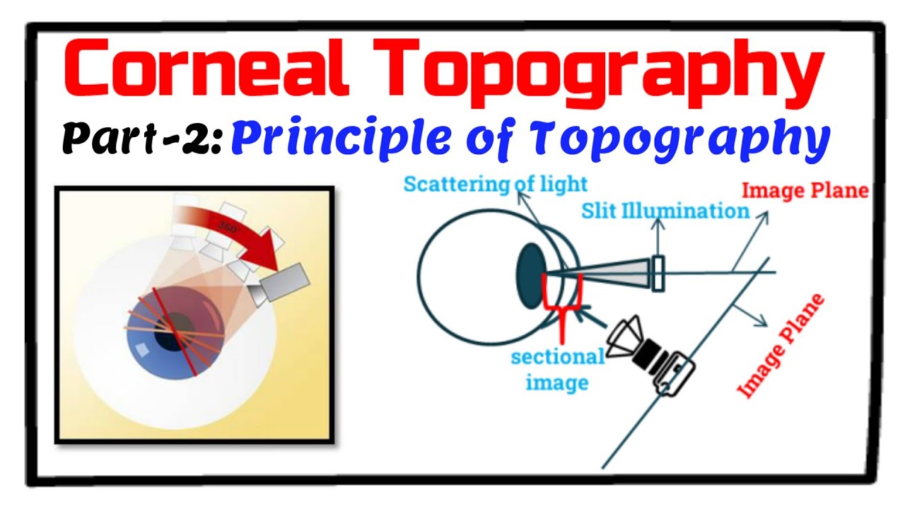 Corneal Topography Principles of Videokeratography(VKG), Keratoscope